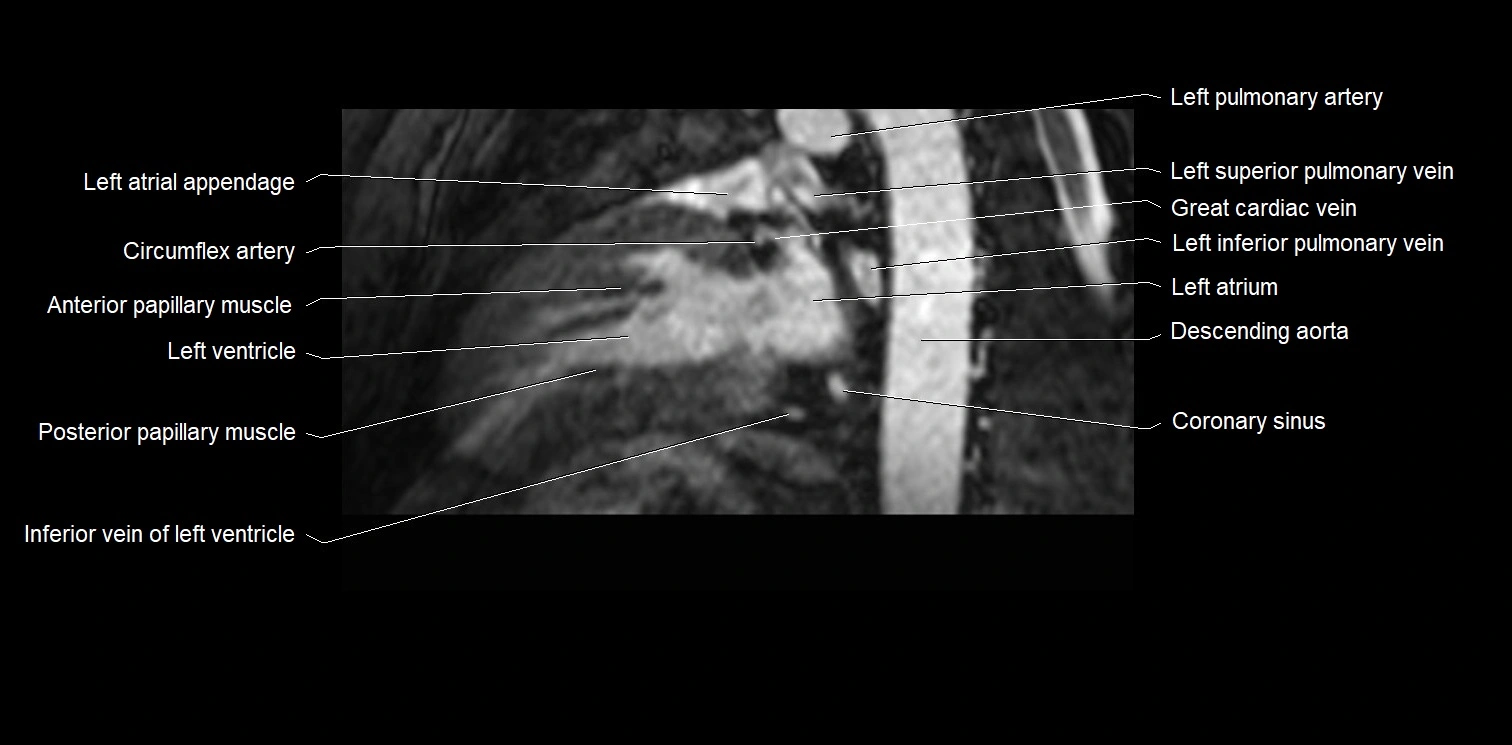 MRI heart and coronary arteries two chamber(sagittal)  anatomy image 32.webp